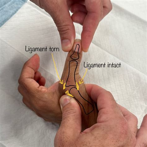 thumb ligament tear test|thumb ligament injury symptoms.